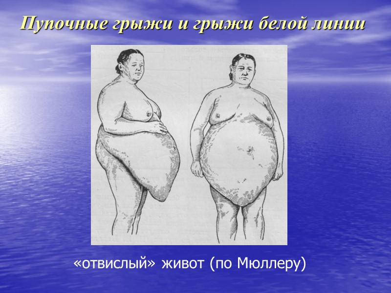 Пупочные грыжи и грыжи белой линии «отвислый» живот (по Мюллеру)